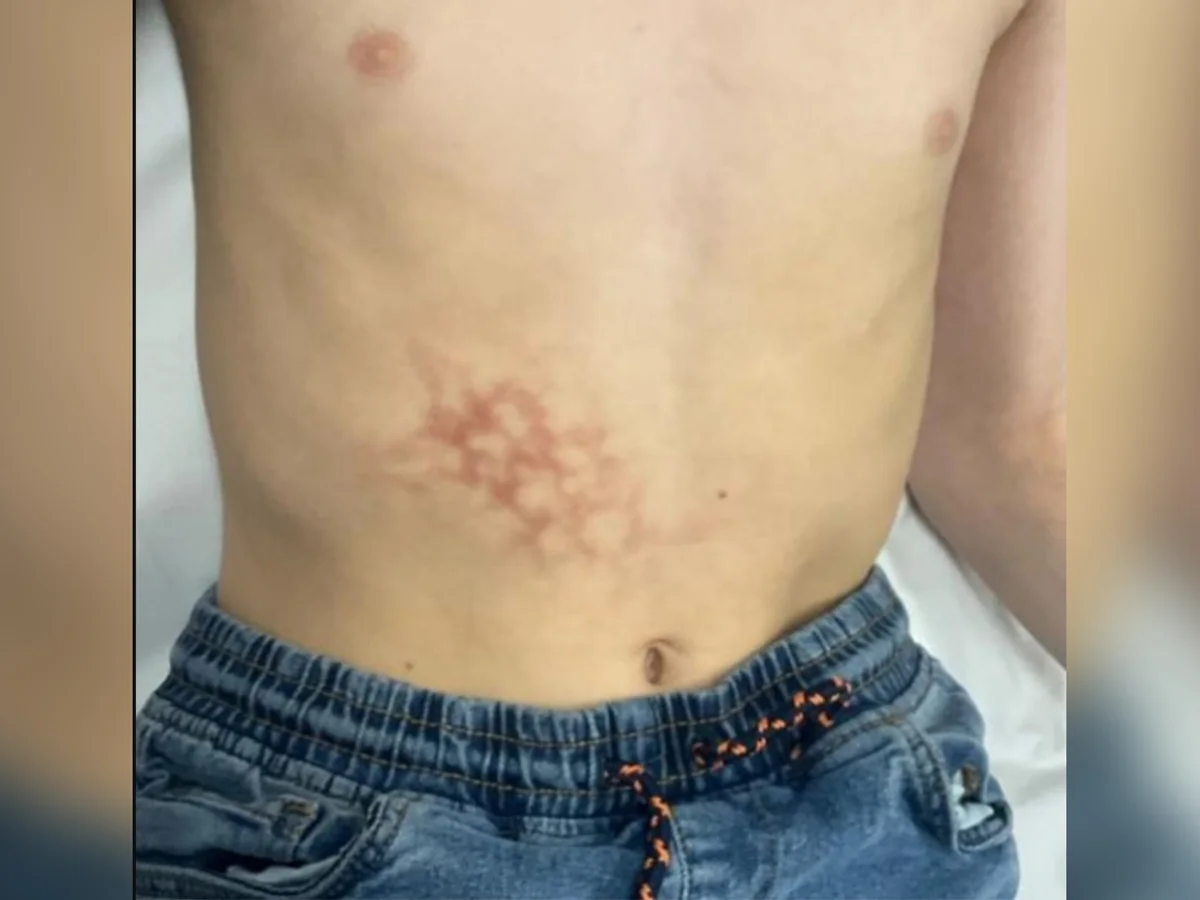 Menino desenvolve dermatose rara por usar notebook encostado na barriga