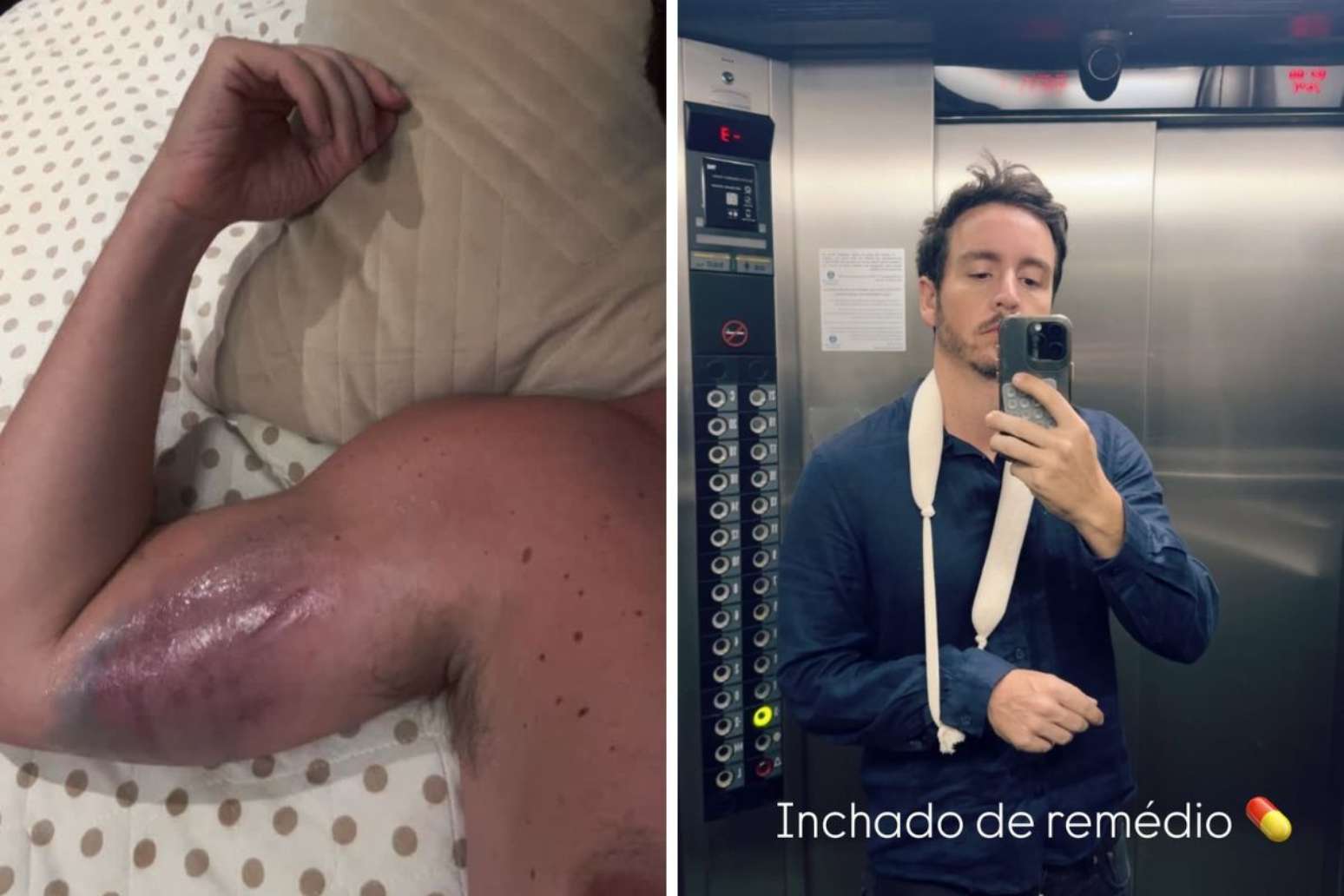 Wagner mostra hematoma ap&oacute;s acidente em academia; ator mostra incha&ccedil;o ap&oacute;s tomar medicamento
